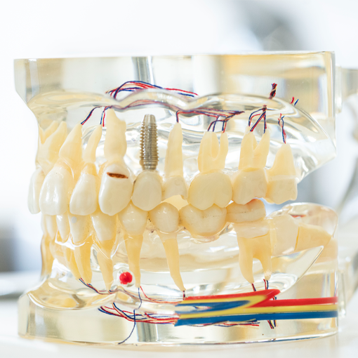 dental implant model