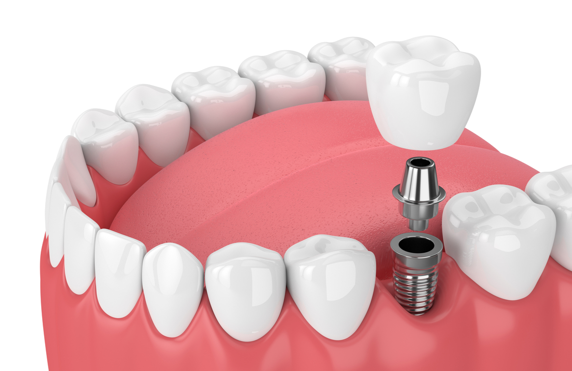 3-D rendered image of a single tooth dental implant