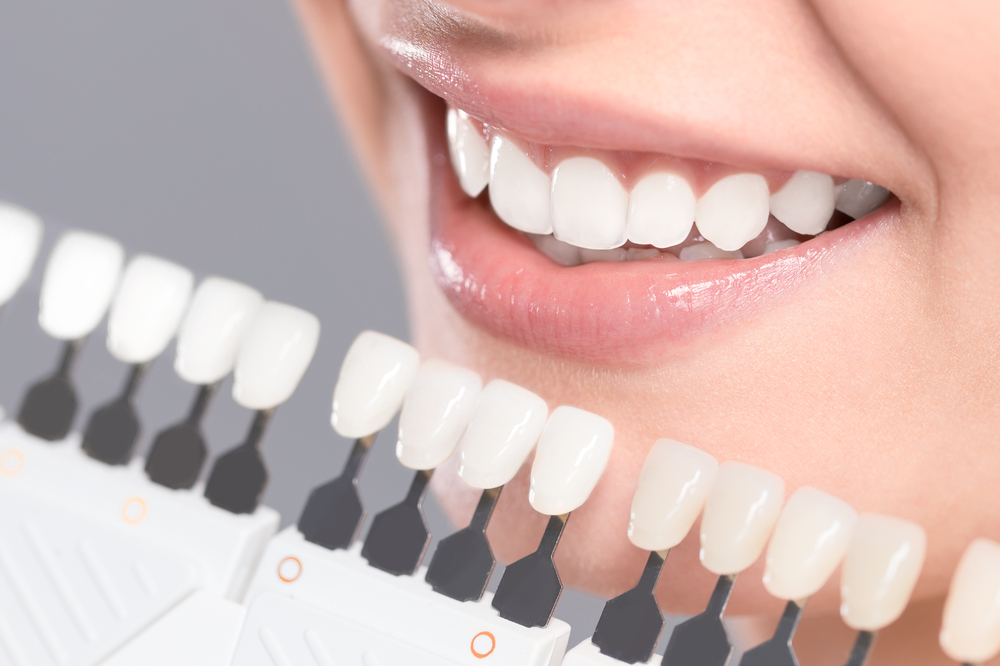 teeth whitening colour matching