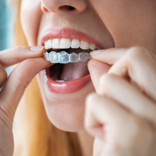 shutterstock_1738202456 (1) woman placing her Invisalign trays on her teeth