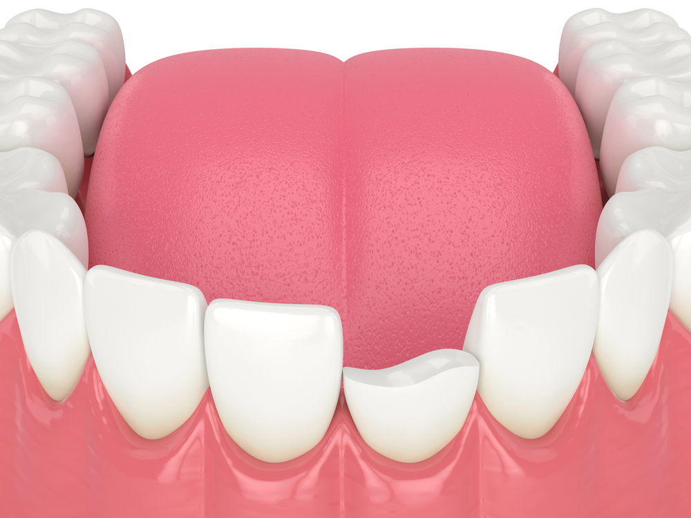 chipped tooth