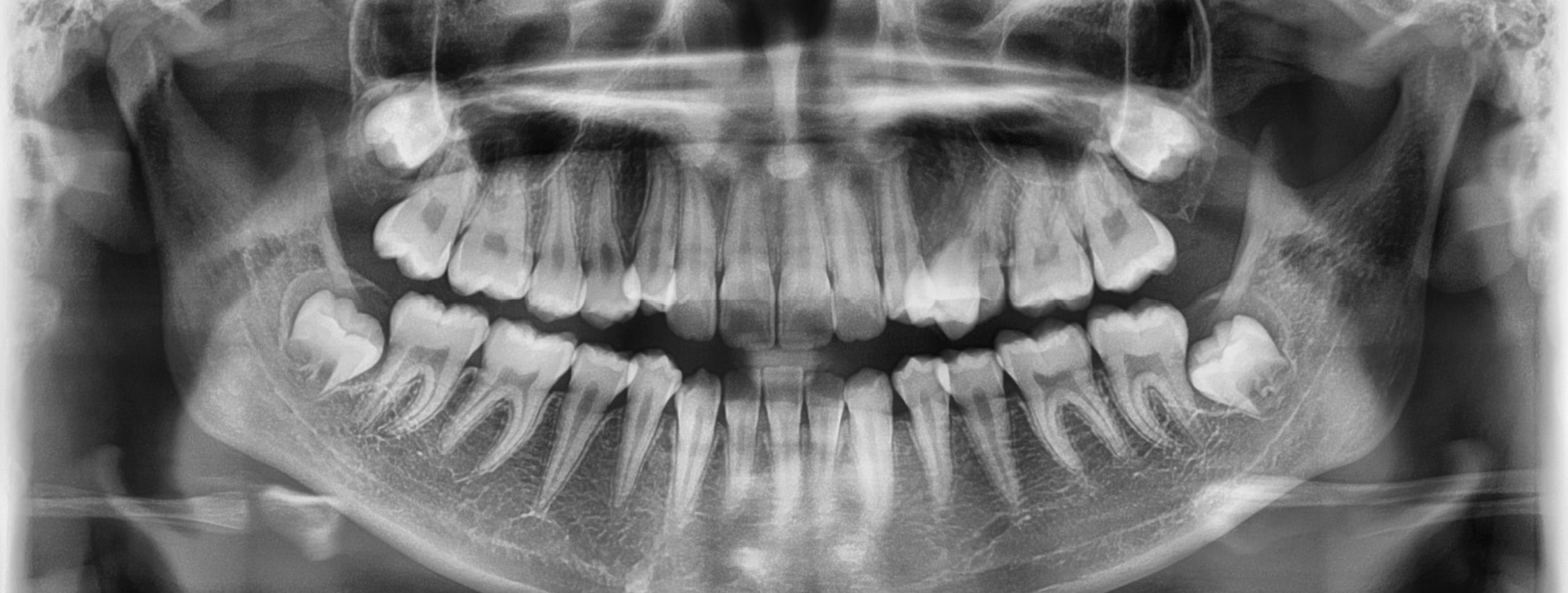 Wisdom Teeth Removal X-Ray of Dental Patient