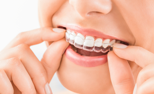 Woman Wearing Orthodontic Invisible Braces - Invisalign Ottawa