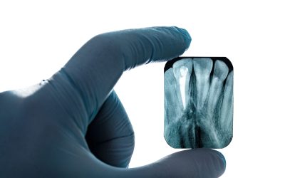 Root Canal vs. Tooth Extraction: Which Option Is Better?