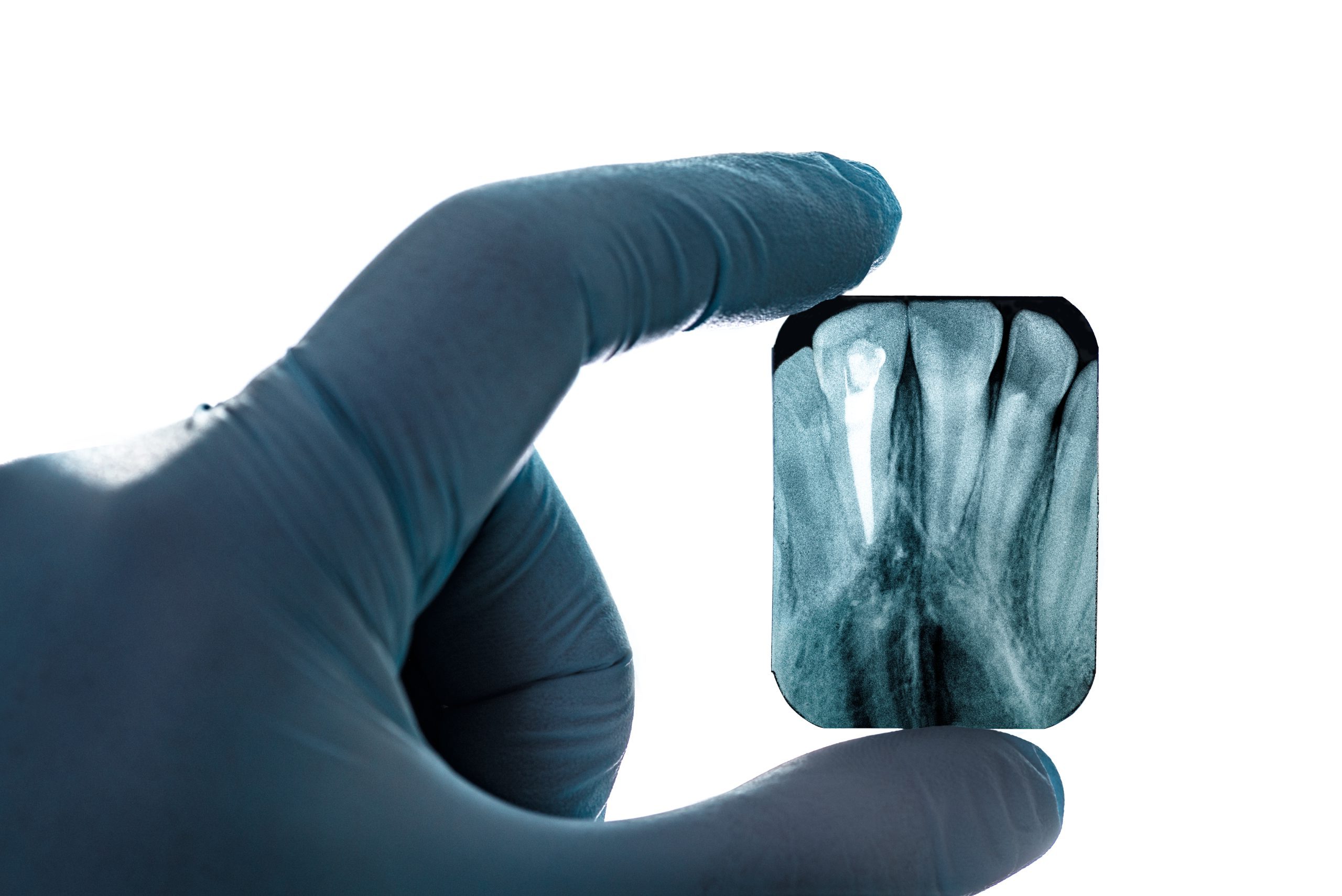 Radiography,Imaging,Teeth,Upper,Canines,Root,Canal,Hand,In,Glove root canal xray